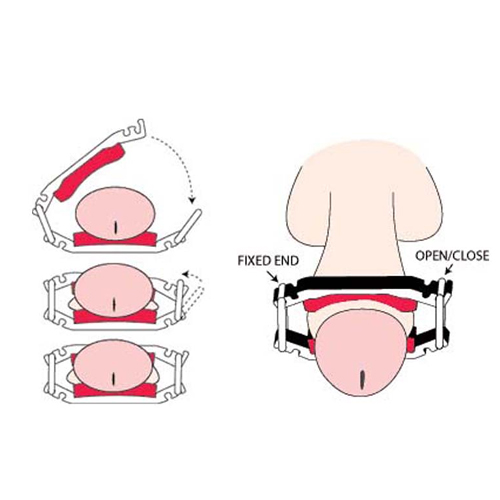 Dribblestop Male Incontinence Clamp - Penile clamps (2) to stop embarrassing dribbles & - Dribblestop Male Incontinence Clamp